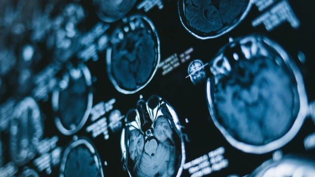 Tomografía de un cerebro